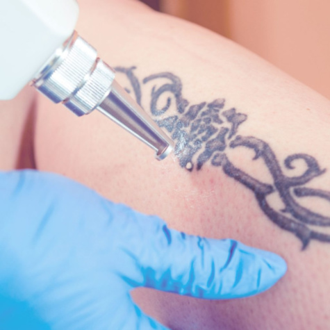 Laser Tattoo Removal 